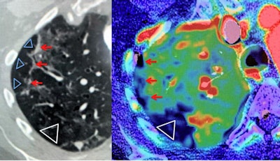 Chest CT perfusion angiography in COVID-19. A COVID-19 positive-tested 54-year-old woman presented with fever and dry cough lasting 10 days, with clinical suspicion of pulmonary embolism. Left image: Chest baseline CT of the right upper lobe with subpleural bands of organizing pneumonia (red arrows), surrounded by small ground-glass opacities (GGOs). Right image: CT perfusion angiography image shows multiple small subpleural perfusion defects (red arrows) and a larger perfusion defect dorsal in the normal ventilated right upper lobe (Δ on left image), due to microvascular obstruction (Δ on the right image). CT angiography showed no pulmonary emboli in the right pulmonary upper lobe, resulting in perfusion/ventilation mismatch. Scan parameters: conventional dynamic perfusion CT, Somatom Drive, Siemens; scan volume 8.4 cm (aorta arch -- left atrium); 1 mm recon; dual input lung perfusion 4D, Vitrea, Vital, Canon. Courtesy of BJR and department of radiology, Haaglanden Medical Centre, The Hague, the Netherlands.