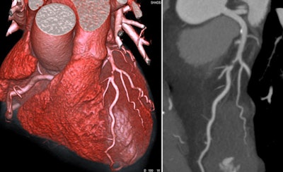 High-grade stenosis of the left anterior descending coronary artery in 3D reconstructed and 2D coronary CT angiography. All clinical images courtesy of Prof. Dr. Stephan Achenbach.