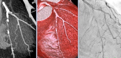 Comparison of the spatial resolution of coronary CT angiography and invasive coronary angiography: long, subtotal left anterior descending coronary artery stenosis with a collateral from the diagonal branch.