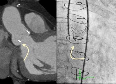 Paravalvular leak of an aortic valve bioprosthesis. In CT angiography, size and location of the leak as well as the optimal projection for fluoroscopic visualization can be determined (left). Right: interventional closure.