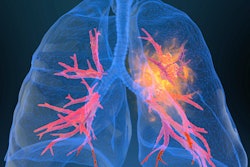 2020 11 16 17 05 4053 Lung Cancer2 400