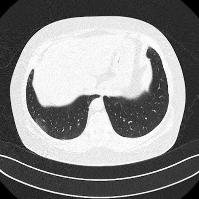 CT image from a 62-year-old woman with long-term COVID-19 symptoms