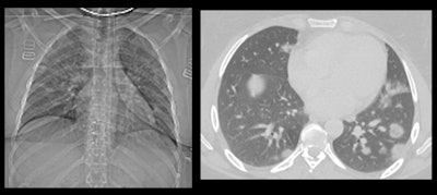 This patient had fever and abdominal pain for seven days and appeared to have appendicitis. The surgeon reported that the patient had no COVID-19 symptoms, but a radiologist correctly diagnosed COVID-19. All images courtesy of Dr. Sam Hare.