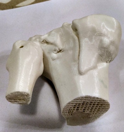 3D-printed anatomical model using stereolithography technology shows segment of the knee. The fracture line is located on the tibial bone. Printing on an Ultimaker 2 machine took 18 hours using polylactic acid, a thermoplastic polymer derived from renewable resources, such as corn starch or sugar cane. The cost was around 30 euros.