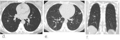 Example chest CT scans of a patient with a false-positive CO-RADS 4 score. (d, e) Two axial slices and (f) a coronal slice of a 51-year-old female with two days of symptoms. CT shows bilateral multifocal areas of consolidation with halo and subtle areas of ground glass without contact to visceral pleural surfaces. RT-PCR for SARS-CoV2 was repeatedly negative and an alternative diagnosis was established with a blood culture-confirmed line sepsis. Images and caption courtesy of the RSNA.