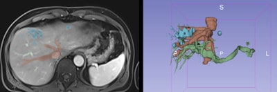 During the segmentation process, several techniques can be used to select the main structures, including thresholding, edge detection, region growing, and multiple-slice interpolation as well as manual segmentation with draw, paint, and erase/cut tools. 3D Slicer, an open-source software platform, was used for these models. All figures courtesy of RSNA 2020 and Nuno Pereira da Silva.