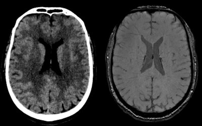 Traumatic brain injury in 64-year-old male skier who had seizures after trauma (broken helmet, Glasgow Coma Scale [GCS] 9/15), psychomotor agitation). CT (left) shows linear hyperdensity adjacent to septum pellucidum. MRI (right) shows susceptibility artifact compatible with hemorrhagic residue in contact with middle part of septum pellucidum on its right lateral surface above the fornix. All figures courtesy of RSNA 2020 and Dr. Mariana Dalaqua.