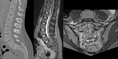 A 28-year-old woman suffered trauma during sledging. Acute fracture of L1 vertebral body with height loss and small backward retreat of posterior wall, as well as multifragmentary sacral fracture, prevertebral, and presacral hematomas. Residual right L5 radiculopathy after surgical fixation.