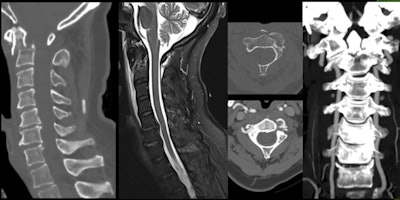 Cervical pain in 57-year-old man after ski fall. Fracture of base of C2 odontoid process with lesion of anterior longitudinal ligament, prevertebral hematoma, and narrowing of left vertebral foramen, without arterial dissection.