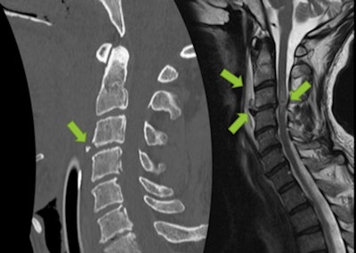 Traumatic injury in 53-year-old man after ski fall (GCS 6/15 onsite). Normal initial brain CT scan, but clinical evaluation was impossible due to intubation onsite. CT revealed teardrop fracture on C3 and subtle retrolisthesis of C3 over C4, suggesting hyperextension discoligamentous injury. MRI confirmed rupture of anterior longitudinal ligament, discal extrusion into prevertebral space, and a hemorrhagic spinal contusion at C3-C4 level. Patient was found to be tetraplegic after extubation.