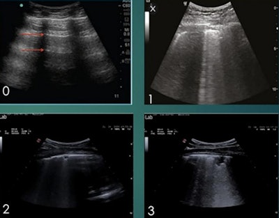 Researchers assigned a lung ultrasound score of 0-3 corresponding with disease severity for 14 unique lung sections. Image courtesy of Umberto Sabatini and the ASA.