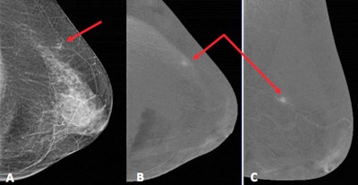 Above: Mammographic images (A-C) show small enhancing focal asymmetry in upper external quadrant of left breast (red arrows). Below: Ultrasound image shows the enhancement asymmetry corresponds to well-defined hyperechogenic nodule (blue arrows). A biopsy confirmed local inflammatory changes related to fat necrosis. Figure and table courtesy of RSNA 2020 and Dr. M.C. Arízaga, Dr. M. Montés Fernández, et al.