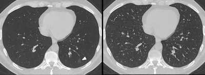 A 37-year-old man presented to the emergency department with cough and fever. An immediate CT scan was performed due to suspected pulmonary COVID-19 manifestation. Left: The axial minimum intensity projection (MinIP) reconstruction shows focal subtle ground-glass opacity in the left lower lung lobe (arrowhead) suspicious for early-stage pulmonary COVID-19, which was missed on axial multiplanar reformat series (Right) by 6/6 readers in this study. Real-time reverse transcription polymerase chain reaction confirmed severe acute respiratory syndrome coronavirus 2 infection. All figures courtesy of EJR and Dr. Christian Booz and colleagues.
