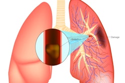 2021 01 06 16 36 9509 Pulmonary Embolism Illustration 400