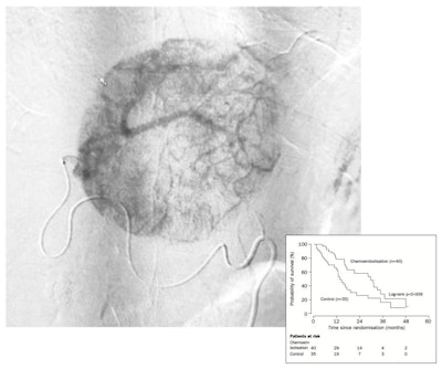 Image above of a transarterial chemoembolization procedure. The patient survived for 22 months from the time the image was taken