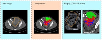 Individual and combined ovarian biopsy scans. Images courtesy of Prof. Evis Sala, PhD, of the University of Cambridge.