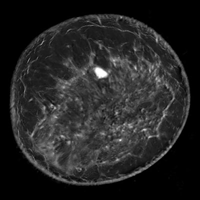 QT Imaging's technology uses transmission ultrasound to acquire breast images. Image courtesy of QT Imaging.