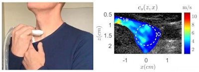 Left: A volunteer holds a linear ultrasound probe to help prove the feasibility of vocal passive elastography. Right: 2D shear wave speed as calculated by the new technique mapped onto an anatomical brightness mode ultrasound image. Image courtesy of Steve Beuve.