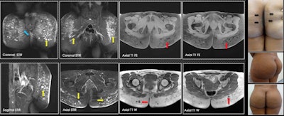A 35-year-old patient was injected with biopolymers in the gluteal region five years ago. Three years later, changes in the coloration of the skin are visible between the gluteal folds (blue arrows). On MRI, there are multiple vacuoles of hyperintense behavior in the short-tau inversion recovery sequences (yellow arrows) and vacuoles of hypointense behavior in the sequences with T1-weighted information (red arrows), which are compatible with biopolymers located mainly in subcutaneous tissue. In the gluteus maximus muscle, biopolymers are seen in the fusion form (blue arrow). No vacuoles were identified at this level.