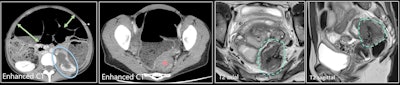 A 39-year-old woman (different from previous figure) with acute clinical intestinal obstruction. Contrast-enhanced CT (first two images) shows small and large bowel distension (green arrows), longstanding left urinary obstruction (blue circle), and mechanical obstruction with rectosigmoid mass (red star). MRI was performed after surgical decompression by colostomy. T2 axial and T2 sagittal images show stellar retractile hypointense T2 mass of the Douglas pouch with colic muscular thickening. Endometriosis of the torus extends transmurally to the rectosigmoid, with stenosis and left ureter involvement.