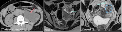 A 42-year-old woman presented with acute left lumbar region pain. She had no history of endometriosis. Left image: CT without contrast shows left hydronephrosis. Middle image: Axial T2 shows dilated left ureter. Right image: Coronal T2 shows retractile, stellar periureteral mass responsible for kidney obstruction. There was no hemorrhagic signal. The suggestion was deep infiltrative endometriosis. A nephrectomy was performed because of the complete loss of left kidney function, and it confirmed the diagnosis of left ovarian and parametrial endometriosis, with a normal ureter.