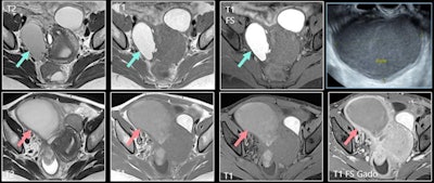A 39-year-old woman was diagnosed with deep pelvic endometriosis. MRI showed typical endometrioma of right ovary; unilocular cyst with hypersignal greater than fat in T1-weighted image (top row, middle image), persisting in T1-weighted fat-suppressed image (top row, right image) and with shading in T2 (top row, left image). Patient presented several months later with pelvic pain, fever, and hyperleukocytosis. Increase in size, loss of shading on T2 (bottom row, left image), loss of hyperintensity on T1-weighted fat-suppressed image, and thick, enhanced wall were consistent with infected endometrioma. Ultrasound-guided drainage led to removal of 250 cc of pus (top right). All figures courtesy of Dr. Caroline Mandoul and RSNA 2020.