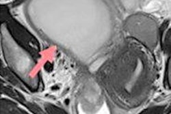 2021 01 20 08 55 0466 2021 01 20 Acute Endometriosis Image1 Version2 20210120081840