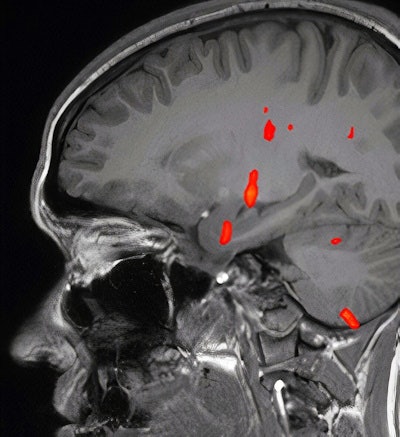 Fused Blood oxygenation level-dependent (BOLD) map on sagittal T1-weighted image shows activation at the level of anteromedial temporal lobe, thalamus, and other regions, but absent activation of the orbitofrontal cortex. Images courtesy of Dr. Khaled Gad, PhD.