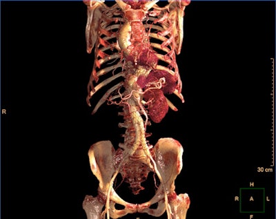 IntelliSpace Portal 12 includes a photorealistic volume-rendering mode. Image courtesy of Philips Healthcare.