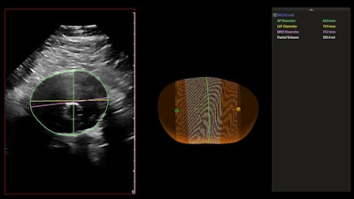 The AAA model provides measurements including the maximum anterior-to-posterior diameter and partial volume of the aneurysm, while also indicating the centerline. Image courtesy of Philips Healthcare.