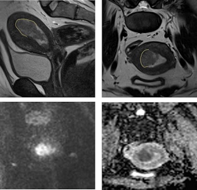 Sagittal (top left) and axial (top right) T2-weighted, diffusion-weighted (b1000 sec/mm2; bottom left), and apparent diffusion coefficient map (bottom right) MR images in an 18-year-old patient with confirmed endometrial intraepithelial neoplasia. MRI is critical to confirm eligibility for FST by excluding myometrial invasion, as in this case (dotted line).