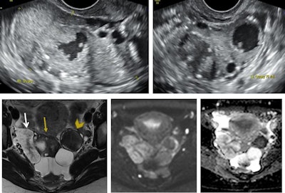 Transvaginal ultrasound images of the right ovary (top left image) and left ovary (top right image) in a 31-year-old nulliparous patient. Both ovaries are enlarged and heterogeneous with solid and cystic areas. Follow-up MRI with axial T2-weighting (bottom left image), diffusion-weighting (b1000 sec/mm2; middle image), and apparent diffusion coefficient map (bottom right image) show right ovary (yellow arrow) with adjacent solid tissue (white arrow) and abnormal left ovary (yellow arrowhead). Operative findings reported a 5 cm cluster of papillary tissue protruding from the right and left ovaries with two cysts. Perioperative biopsy confirmed bilateral borderline serous ovarian tumor and bilateral salpingo-oophorectomy was performed, associated with infracolic omentectomy and peritoneal biopsies.