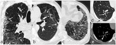 Chest follow-up CT findings of COVID-19 pneumonia: (a) traction bronchiectasis; (b) parenchymal bands; (c) honeycombing; (d, e) thickening of adjacent pleura. Images and caption courtesy of the RSNA.