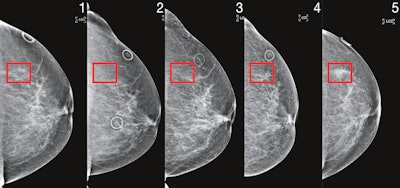 Patient identified as high risk by Mirai four years before cancer diagnosis. Image courtesy of MIT's Computer Science and Artificial Intelligence Laboratory.