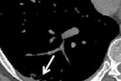 2021 02 01 16 09 7454 2021 02 01 Chest Ct Lung Damage Post Covid Figure2 E