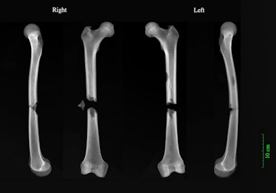 X-rays of perimortem butterfly fractures to both femora of an adult male (PSN 531) buried in the Augustinian friary, Cambridge. All images courtesy of Reveal Imaging and Jenna Dittmar, PhD.