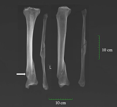 X-ray of antemortem spiral fracture of the tibia and fibula complicated by osteomyelitis (arrow indicates the cloaca) on an adult male (PSN 93) from the Hospital of St John, Cambridge.