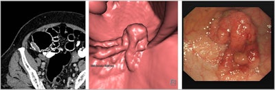 CTC axial supine image, endoluminal image, and the corresponding colonoscopy of a polyp in the cecum. Courtesy of Dr. Andrew Plumb, PhD.