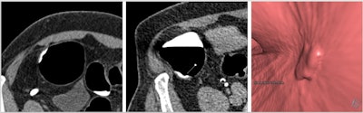 Axial supine, axial prone, and endoluminal CTC images all show a flat cecal polyp. Courtesy of Dr. Andrew Plumb, PhD.