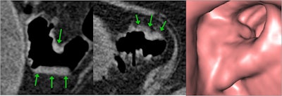 CTC demonstrates proximal sigmoid stricture with typical endoluminal features of adenocarcinoma confirmed on colonoscopy. Courtesy of Dr. Damian Tolan.