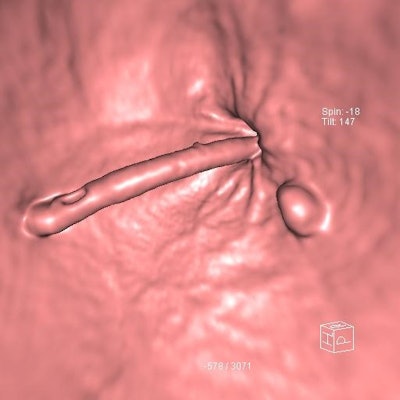 CTC shows a 9-mm adenoma adjacent to the anorectal junction and the rectal catheter. Courtesy of Dr. Damian Tolan.