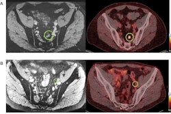 One set of images (A) shows a 7-mm diameter lymph node that is positive on both nano-MRI and PSMA-PET/CT in a patient's left pararectal region. For comparison, the other set of images (B) shows a 4-mm diameter lymph node diagnosed as positive on nano-MRI (left) but negative on PSMA-PET/CT (right) with no Ga-68 PSMA tracer uptake in the region (green circle). Images courtesy of the Journal of Nuclear Medicine.