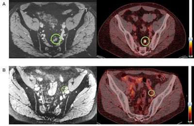 One set of images (A) shows a 7-mm diameter lymph node that is positive on both nano-MRI and PSMA-PET/CT in a patient's left pararectal region. For comparison, the other set of images (B) shows a 4-mm diameter lymph node diagnosed as positive on nano-MRI (left) but negative on PSMA-PET/CT (right) with no Ga-68 PSMA tracer uptake in the region (green circle). Images courtesy of the Journal of Nuclear Medicine.