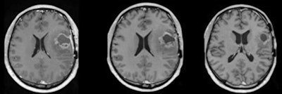 The figure shows longitudinal imaging after treatment. The timing of the scans is a practical solution to assess treatment response, but the approach is not evidence-based and the images do not always give a definitive correlate as to whether the tumor is responding to treatment. We do not truly know if we image too often, too little, or the right amount in terms of morbidity (including quality of life), mortality, and cost-effectiveness, Dr. Tom Booth, PhD, said. Courtesy of Dr. Tom Booth, PhD.