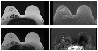 Examples of MR mammography images, courtesy of the University Hospital of Mannheim.