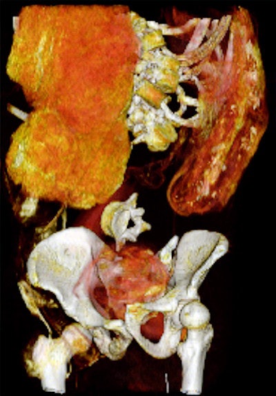 Coronal 3D CT image of lower torso of Seqenenre shows evisceration and embalming material within the abdomino-pelvic cavity. Note the disarticulated vertebrae and disrupted symphyseal articulation.