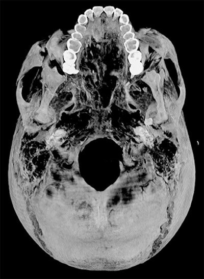 Axial thick slab 3D reconstructed CT image of the external view of the skull base of Seqenenre's shows fracture of the left lip of foramen magnum inflicted by a penetrating injury of the left mastoid bone.