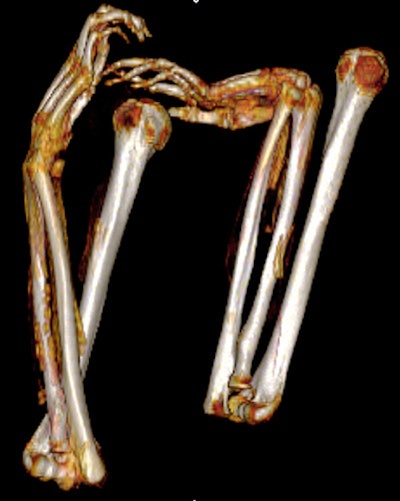 3D frontal CT image of upper limbs of Seqenenre. The arms are dislocated at the shoulder and bent at the elbows. Note the deformity of the bent hands, indicating they were tied at the wrists.