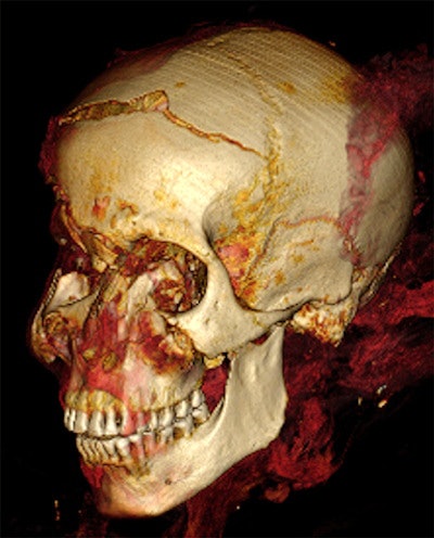 3D CT image of Seqenenre's head in left oblique projection shows an oblique cut wound of the left zygoma and fracture of left coronoid process of the mandible.