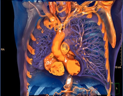 Philips has included new AI algorithms on IntelliSpace Portal 12 designed to detect lung nodules, analyze cardiac function, and quantify pulmonary infiltrates. Image courtesy of Philips Healthcare.
